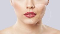 A young girl with a problem skin. Photo before and after treatment for acne.